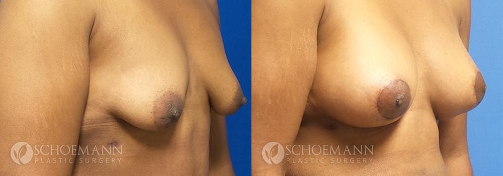 Breast Augmentation Before & After