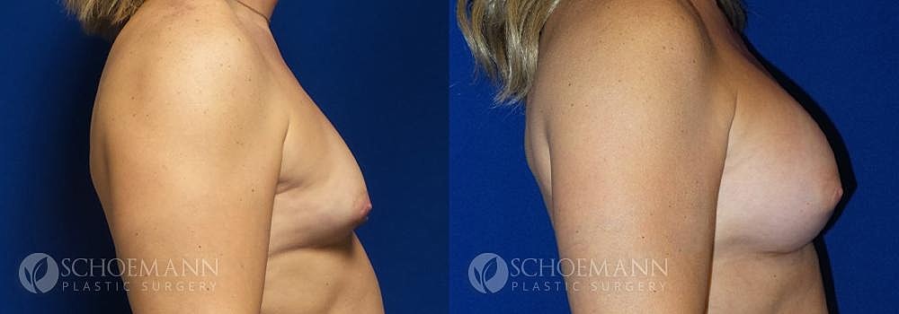 Breast Augmentation Before & After