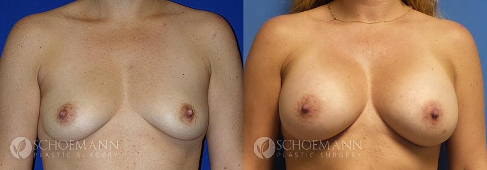 Breast Augmentation Before & After