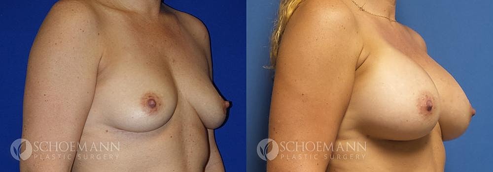 Breast Augmentation Before & After