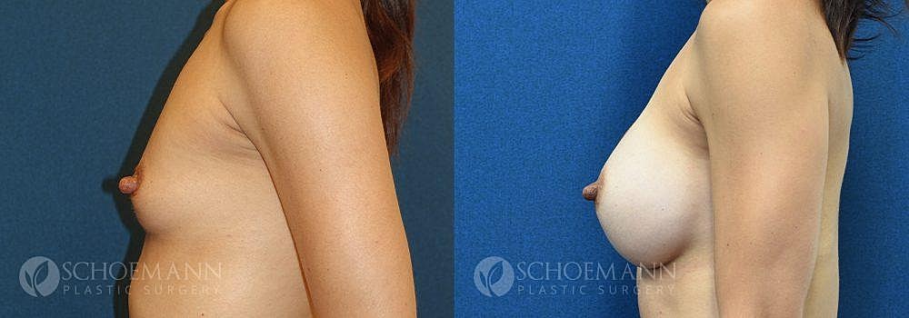 Breast Augmentation Before & After
