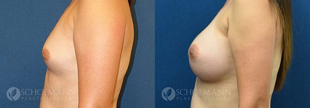 Breast Augmentation Before & After