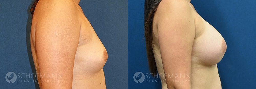 Breast Augmentation Before & After
