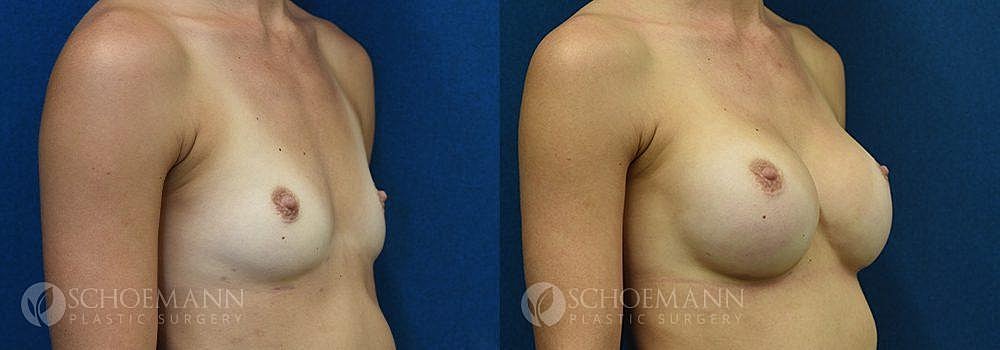 Breast Augmentation Before & After