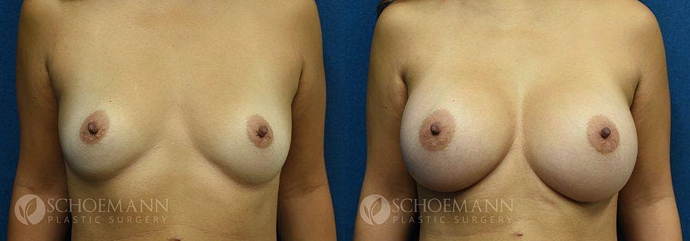 Breast Augmentation Before & After