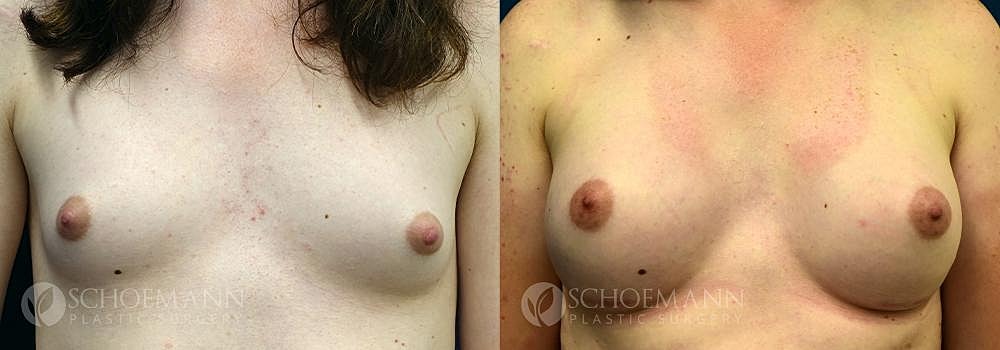Breast Augmentation Before & After