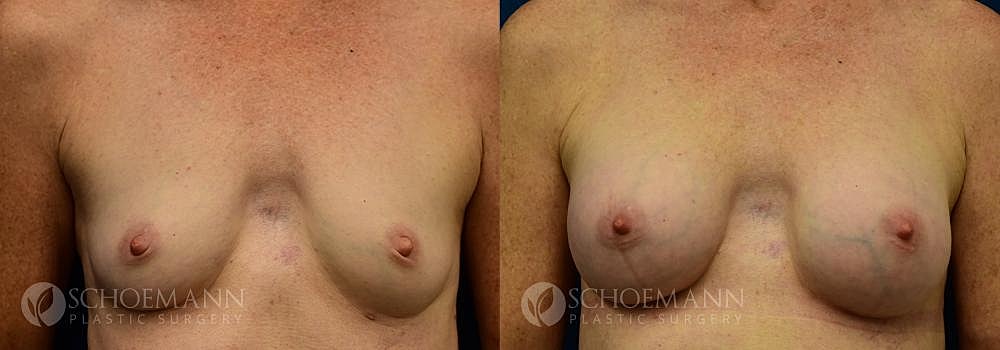Breast Augmentation Before & After