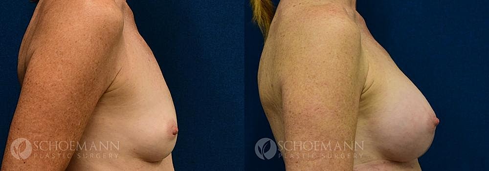 Breast Augmentation Before & After