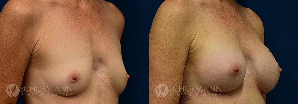 Breast Augmentation Before & After