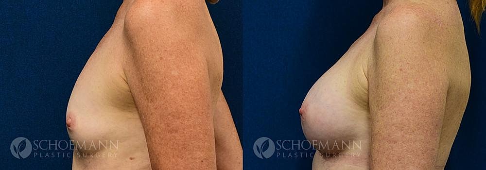 Breast Augmentation Before & After