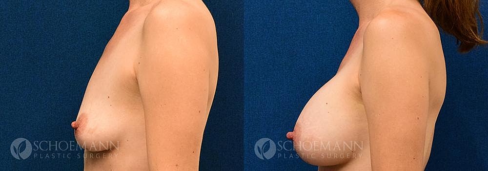 Breast Augmentation Before & After
