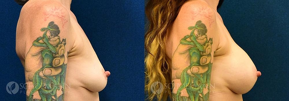 Breast Augmentation Before & After