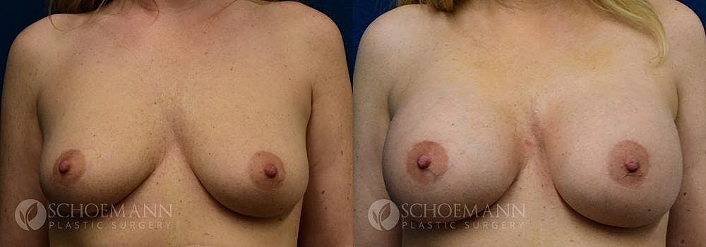 Breast Augmentation Before & After