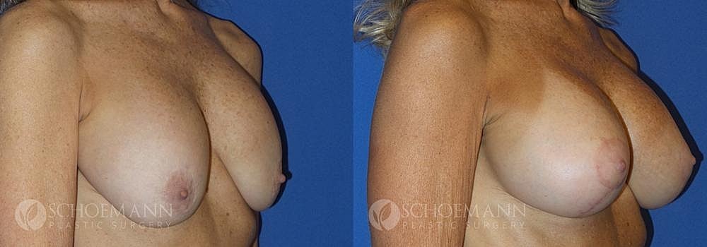 Breast Augmentation Before & After