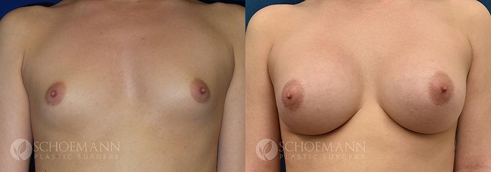 Breast Augmentation Before & After
