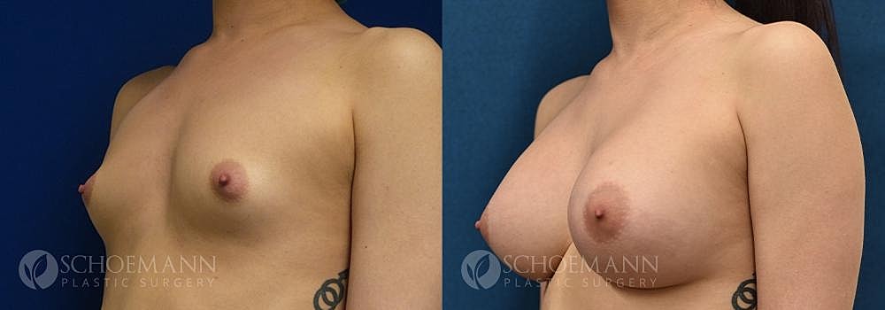 Breast Augmentation Before & After