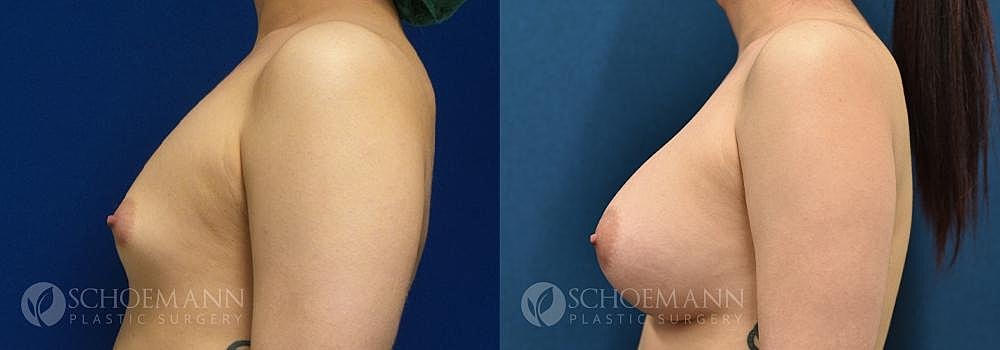 Breast Augmentation Before & After