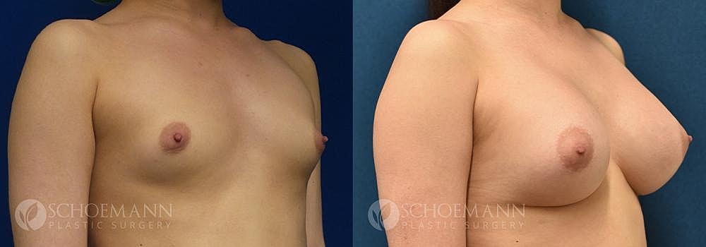 Breast Augmentation Before & After