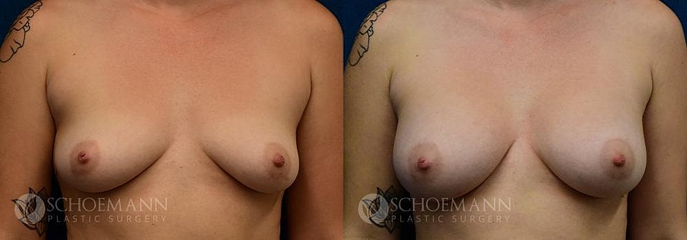 Breast Augmentation Before & After