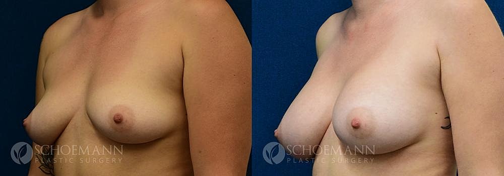 Breast Augmentation Before & After