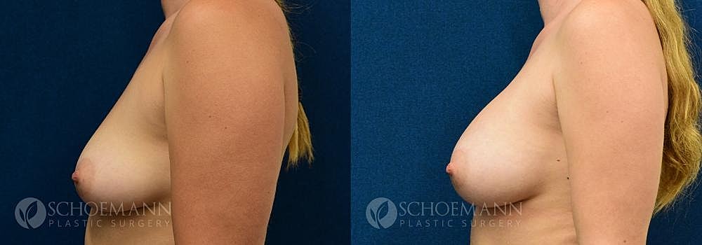Breast Augmentation Before & After
