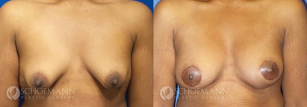 Breast Lift Before & After