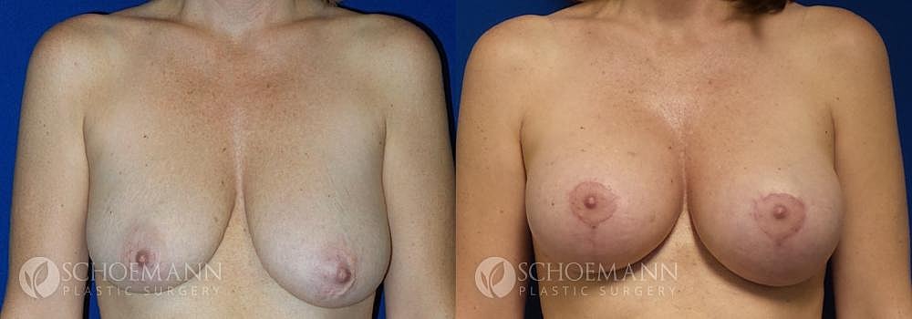 Breast Lift Before & After