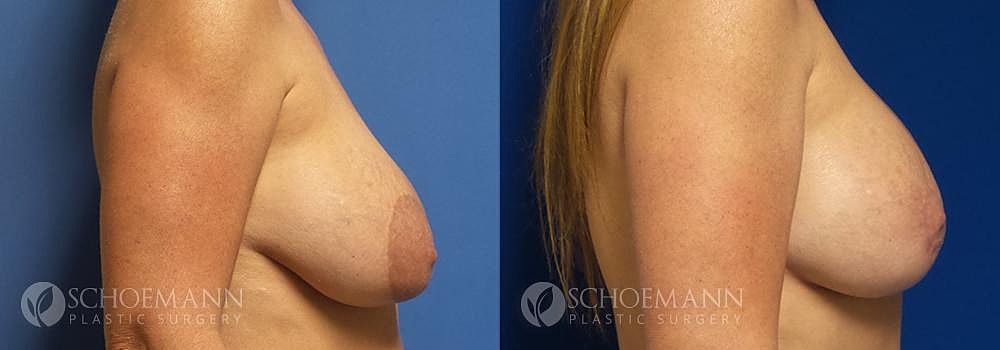 Breast Lift Before & After