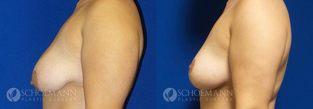 Breast Lift Before & After