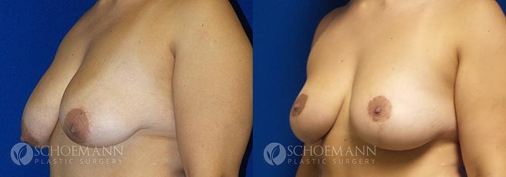 Breast Lift Before & After