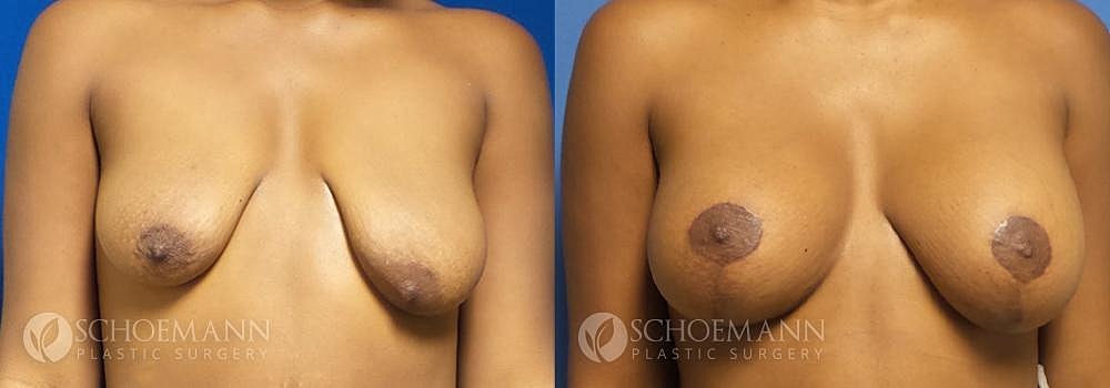 Breast Lift Before & After