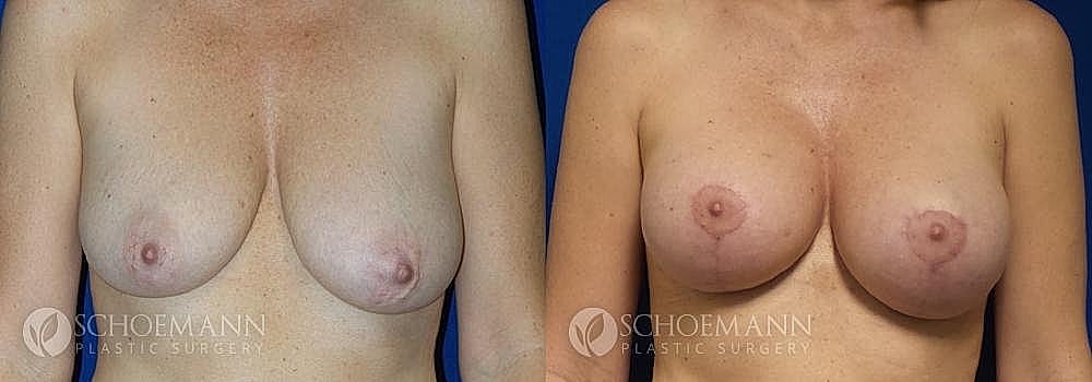 Breast Lift Before & After