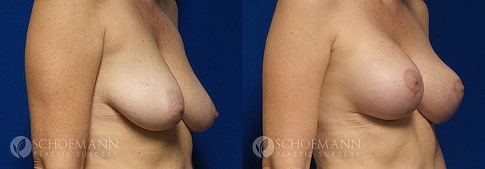 Breast Lift Before & After