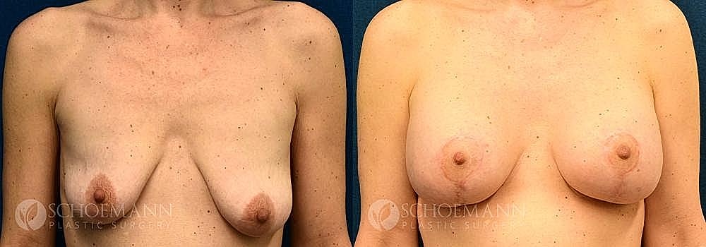 Breast Lift Before & After