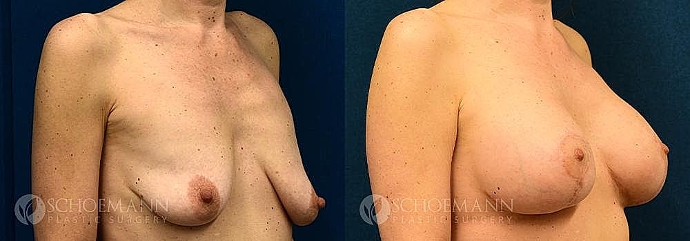 Breast Lift Before & After