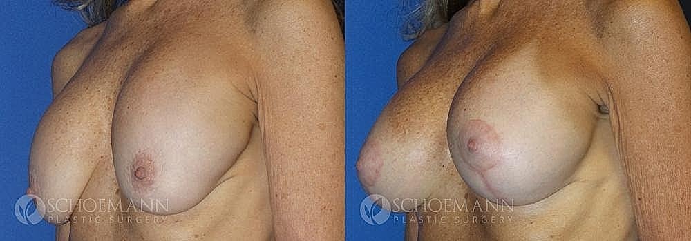 Breast Lift Before & After