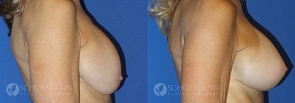 Breast Lift Before & After