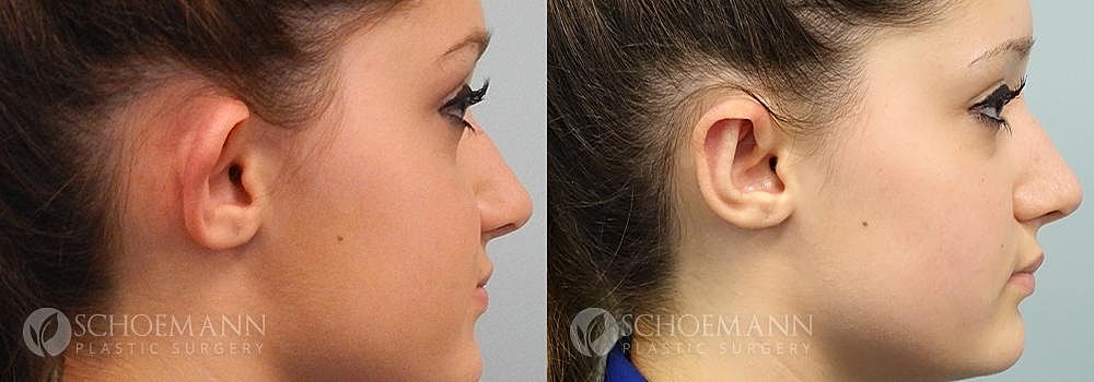 Ear Surgery Before & After