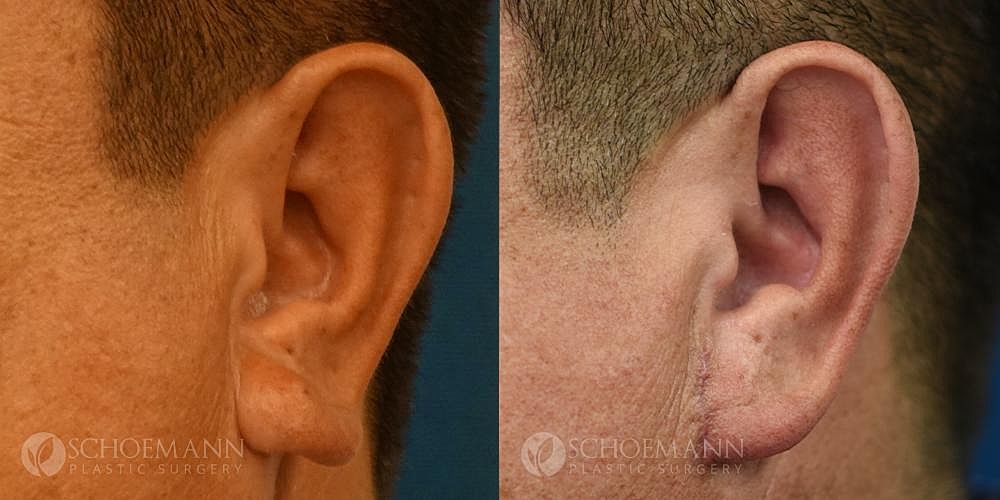 Ear Surgery Before & After