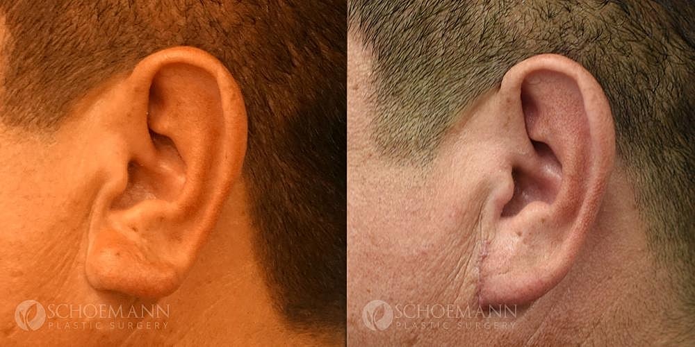 Ear Surgery Before & After