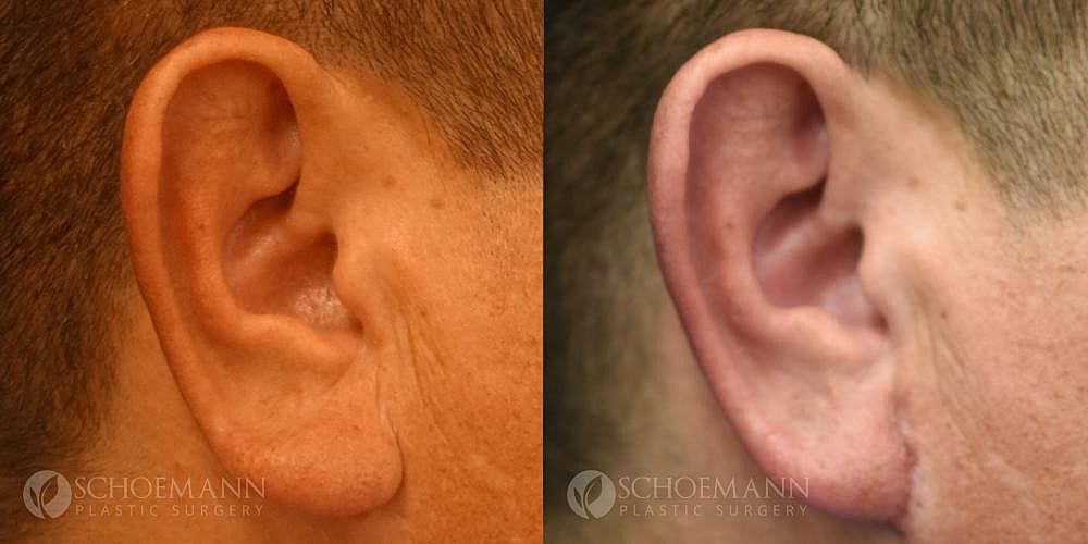 Ear Surgery Before & After