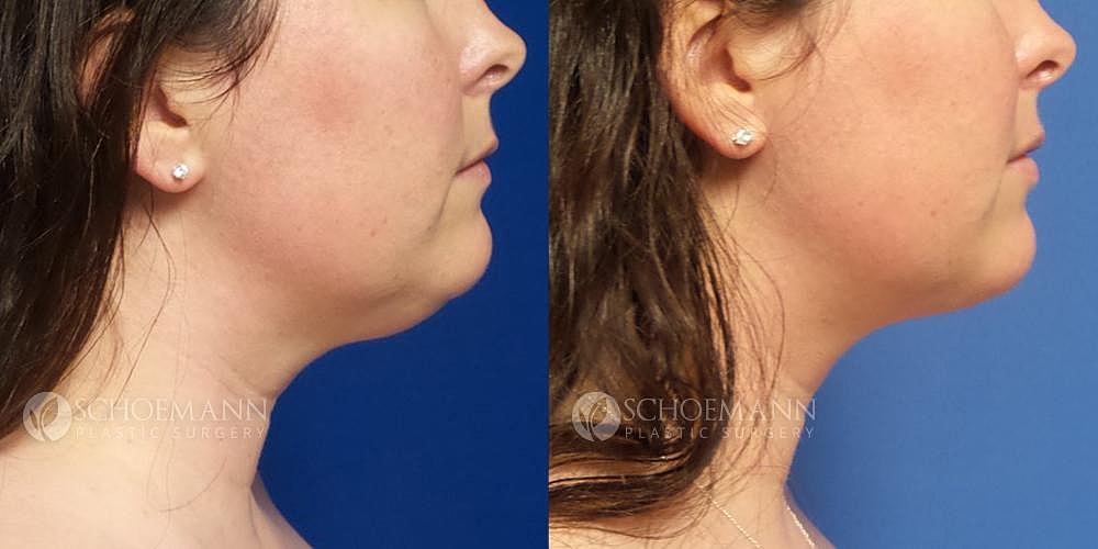 Liposuction Before & After