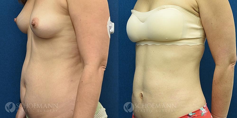 Liposuction Before & After
