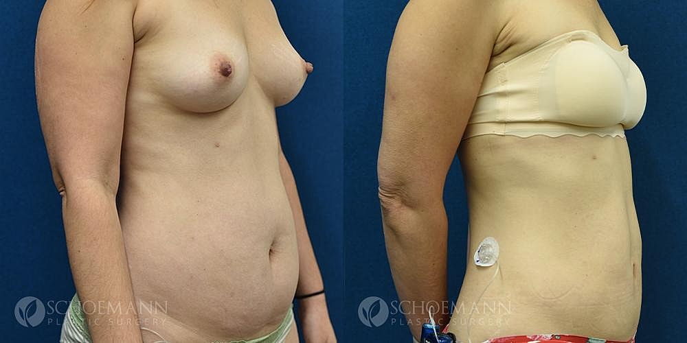 Liposuction Before & After