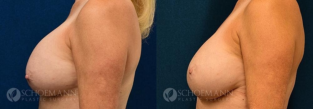 Breast Implant Exchange Before & After