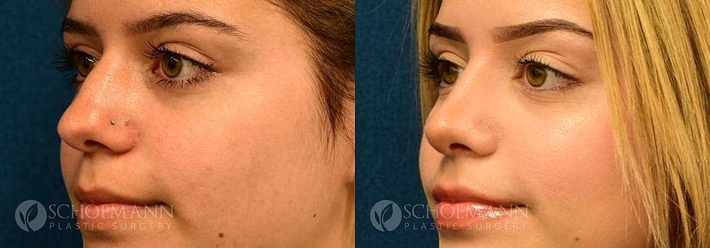 Rhinoplasty Before & After