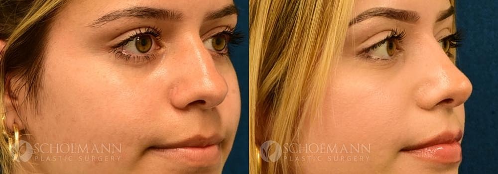 Rhinoplasty Before & After
