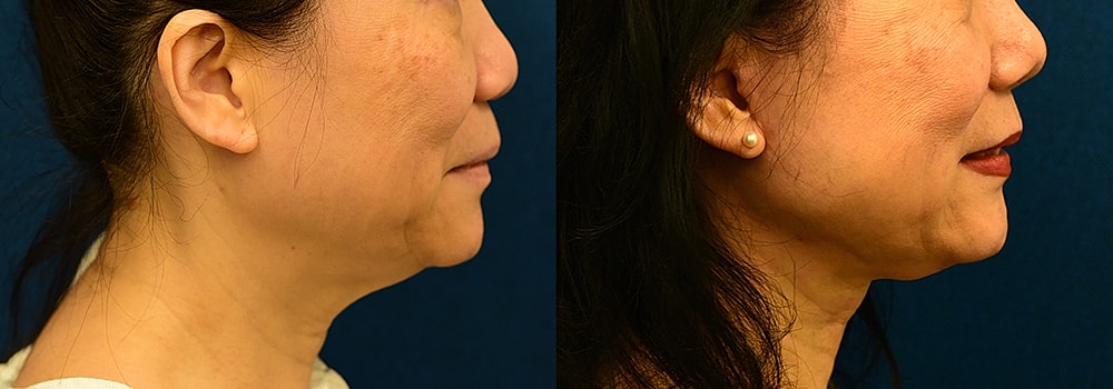 Rhinoplasty Before & After