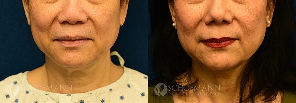Rhinoplasty Before & After