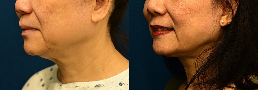 Rhinoplasty Before & After